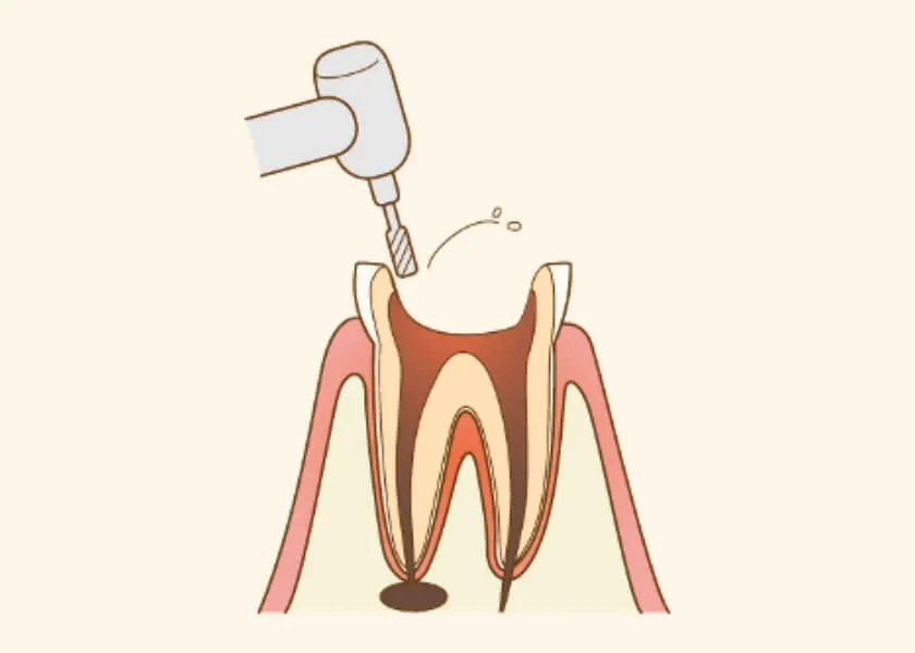 虫歯と歯髄の除去・洗浄